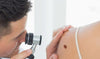 The ABCDE's of Skin Melanoma
